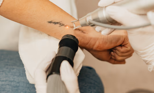 Promień lasera rozbija pigment tatuażu na drobne cząsteczki, które następnie są usuwane przez własny układ odpornościowy organizmu.