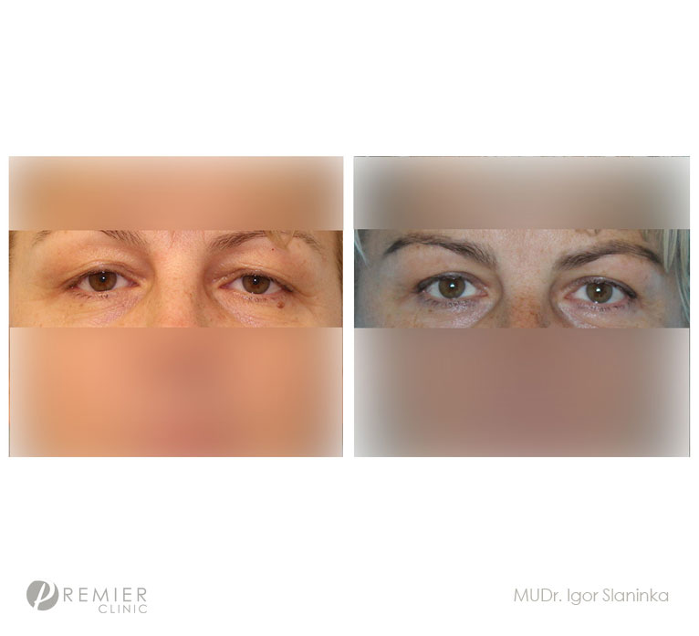 Madonna Eye Lift obrázek 26 MUDr.Slaninka-vicka-eyelift5