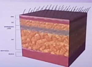 Liposuktions-Technik Diagramm